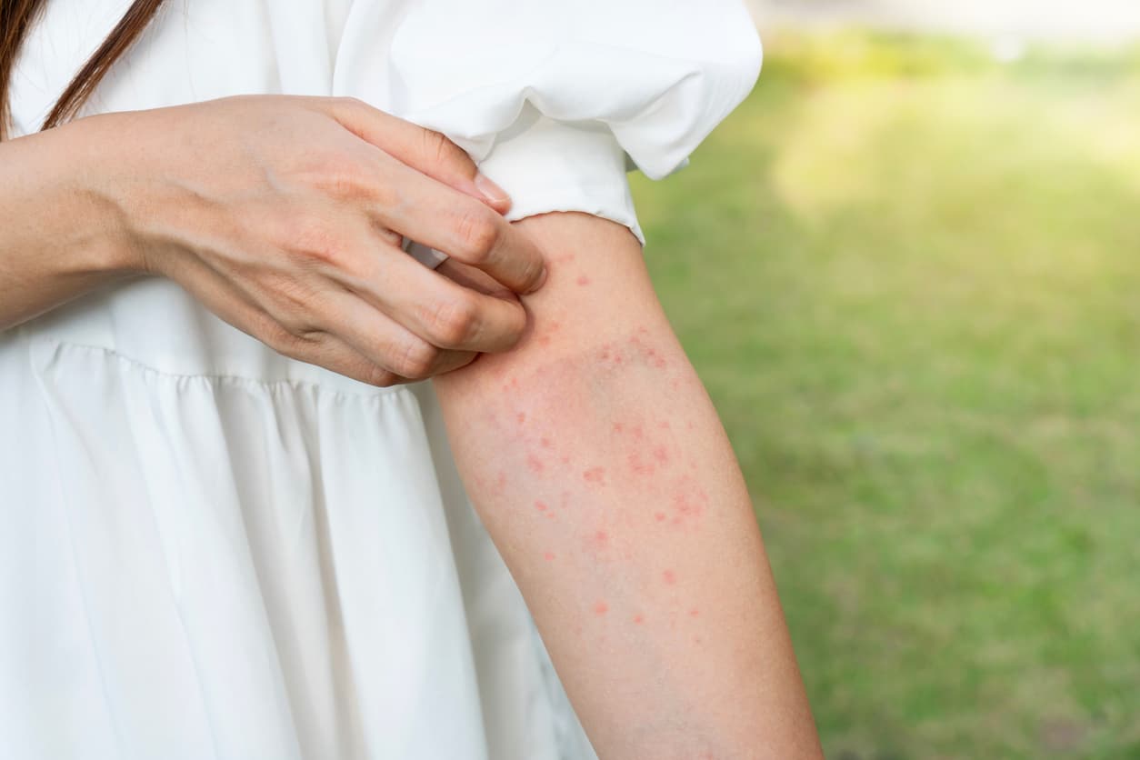 Bite, Bump, or Breakout? How to Tell What’s Really Bugging Your Skin